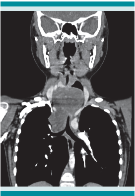 Tomografía computada de tórax que muestra una masa en la parte superior del mediastino.