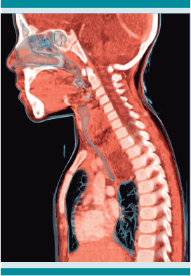 Tomografía de tórax, vista lateral, con una masa en la parte superior del mediastino.