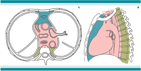 Regiones del mediastino (tomado y modificado de Carter y colaboradores).