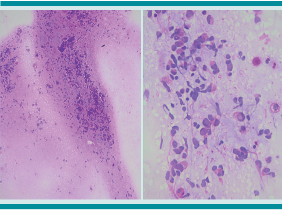 Impronta de la biopsia inicial, que muestra la neoplasia compuesta por células ovoides-fusiformes (4x y 40x).