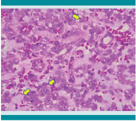 Neoplasia compuesta por células de citoplasma amplio eosinófilo, con atipia moderada, algunas con aspecto rabdoide (puntas de flecha).