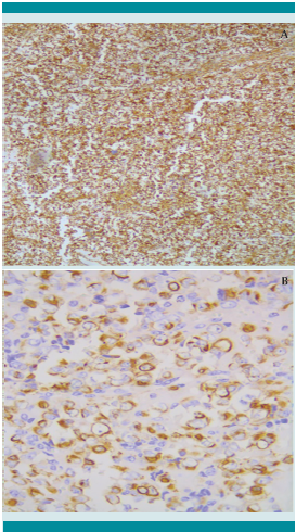 Inmunohistoquímica positiva para vimentina (A) y CK-7 (B).
