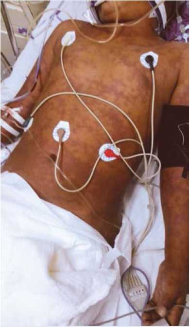 Caso 1. Paciente con exantema purprico y edema generalizado (sptimo da del ingreso hospitalario).