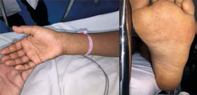 Caso 2. Paciente con exantema petequial generalizado, incluidas las palmas y plantas (sptimo da de hospitalizacin).