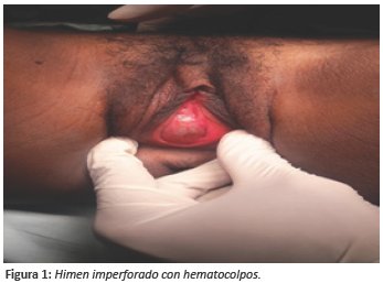 Himen imperforado con hematocolpos.