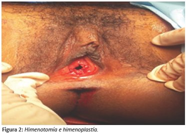 Himenotomía e himenoplastía.