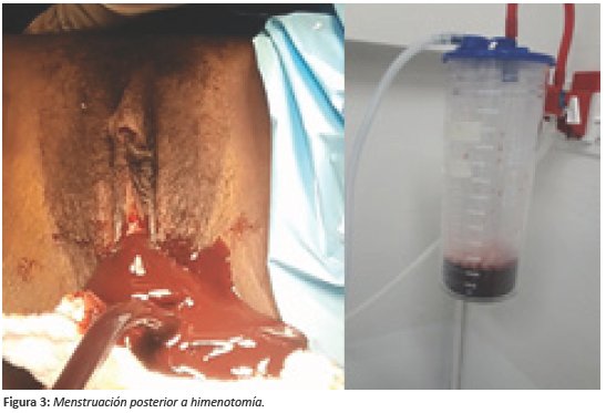 Menstruación posterior a himenotomía.