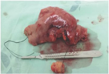 Masa tumoral de 10x8 cm de aspecto carne de pescado