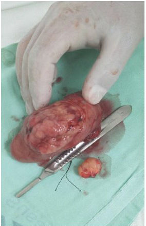 M&uacute;ltiples ganglios en meso de yeyuno de aspecto tumoral