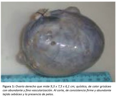 Ovario derecho que mide 9,3 x 7,5 x 6,1 cm; qu&iacute;stico, de color gris&aacute;ceocon abundante y fina vascularizaci&oacute;n. Al corte, de consistencia firme y abundantetejido seb&aacute;ceo y la presencia de pelos.
