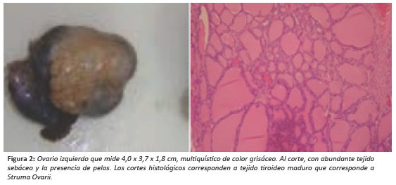 Ovario izquierdo que mide 4,0 x 3,7 x 1,8 cm, multiqu&iacute;stico de color gris&aacute;ceo. Al corte, con abundante tejidoseb&aacute;ceo y la presencia de pelos. Los cortes histol&oacute;gicos corresponden a tejido tiroideo maduro que corresponde aStruma Ovarii.