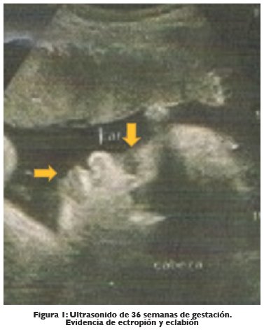 Ultrasonido de 36 semanas de gestación.Evidencia de ectropión y eclabión