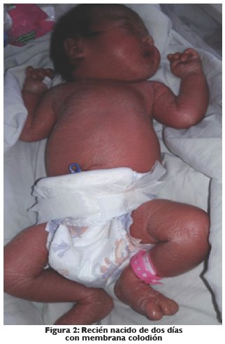 Recién nacido de dos días con membrana colodión
