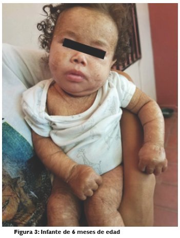 Infante de 6 meses de edad