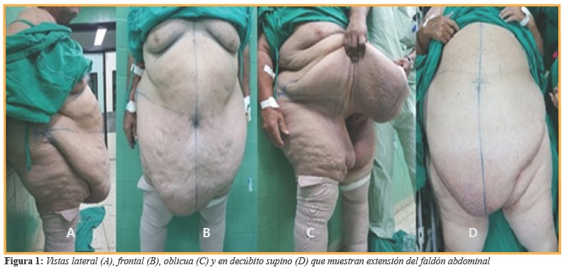 Vistas lateral (A), frontal (B), oblicua (C) y en dec&uacute;bito supino (D) que muestran extensi&oacute;n del fald&oacute;n abdominal