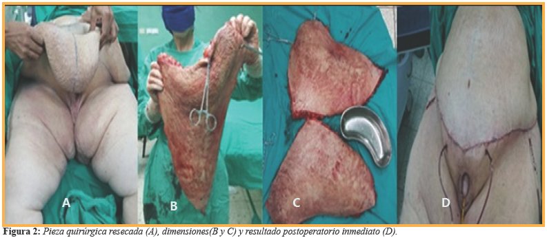 Pieza quir&uacute;rgica resecada (A), dimensiones(B y C) y resultado postoperatorio inmediato (D).