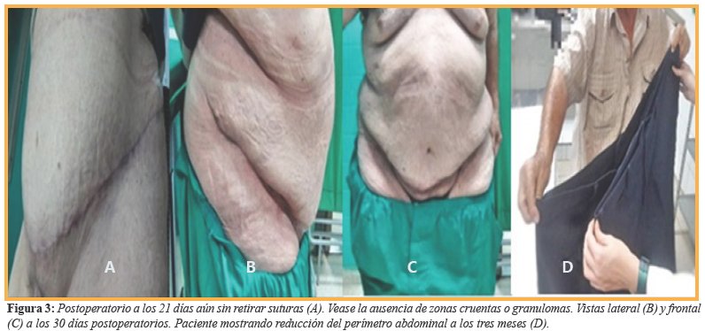 Postoperatorio a los 21 d&iacute;as a&uacute;n sin retirar suturas (A). Vease la ausencia de zonas cruentas o granulomas. Vistas lateral (B) y frontal (C) a los 30 d&iacute;as postoperatorios. Paciente mostrando reducci&oacute;n del per&iacute;metro abdominal a los tres meses (D).