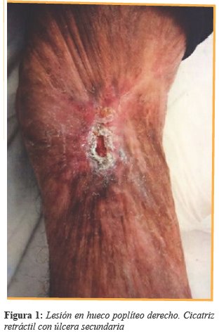 Lesión en hueco poplíteo derecho. Cicatriz retráctil con úlcera secundaria