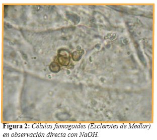 Células fumagoides (Esclerotes de Medlar) en observación directa con NaOH.