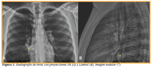 Radiograf&iacute;a de t&oacute;rax con proyecciones PA (A) y Lateral (B), imagen nodular (*).
