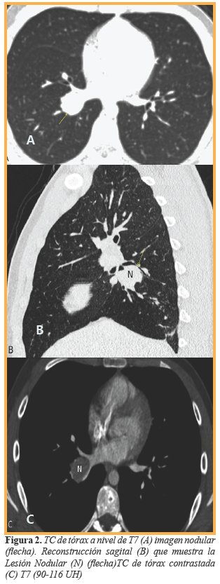 TC de t&oacute;rax a nivel de T7 (A) imagen nodular (flecha). Reconstrucci&oacute;n sagital (B) que muestra la Lesi&oacute;n Nodular (N) (flecha)TC de t&oacute;rax contrastada (C) T7 (90-116 UH)