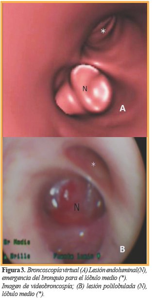 Broncoscop&iacute;a virtual (A) Lesi&oacute;n endoluminal(N), emergencia del bronquio para el l&oacute;bulo medio (*).Imagen de videobroncosp&iacute;a; (B) lesi&oacute;n polilobulada (N), l&oacute;bulo medio (*).