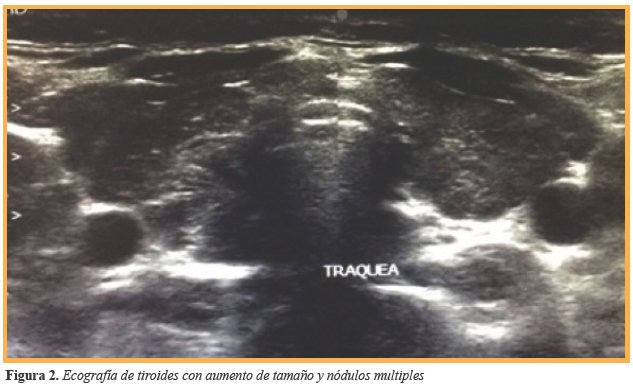 Ecografía de tiroides con aumento de tamaño y nódulos multiples