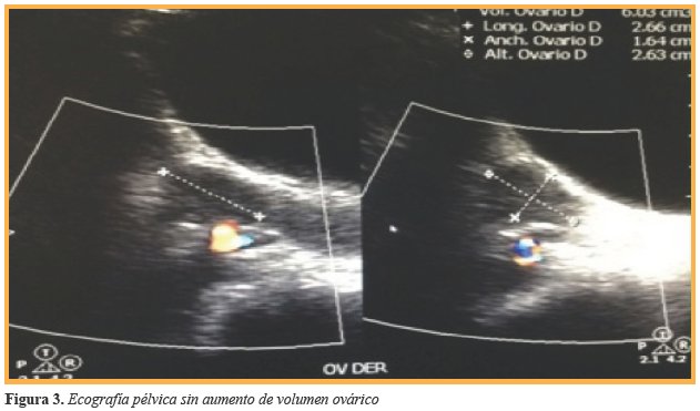 Ecografía pélvica sin aumento de volumen ovárico