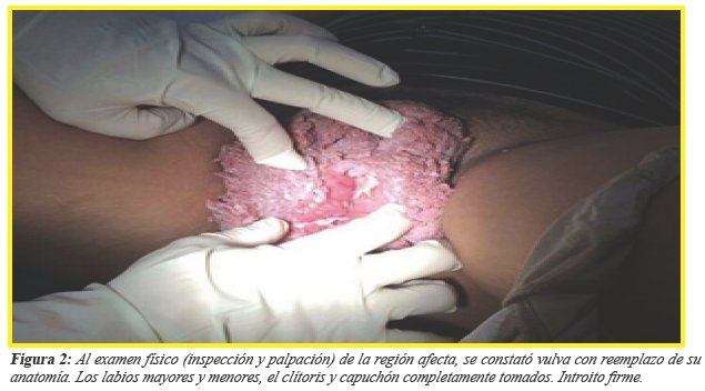 Al examen f&iacute;sico (inspecci&oacute;n y palpaci&oacute;n) de la regi&oacute;n afecta, se constat&oacute; vulva con reemplazo de su anatom&iacute;a. Los labios mayores y menores, el cl&iacute;toris y capuch&oacute;n completamente tomados. Introito firme.