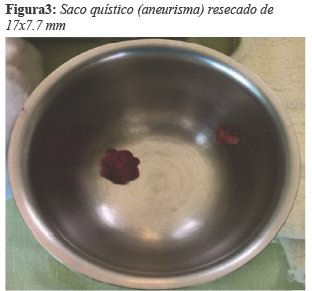 Saco qu&iacute;stico (aneurisma) resecado de 17x7.7 mm
