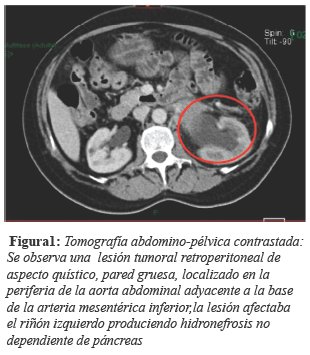 Tomograf&iacute;a abdomino-p&eacute;lvica contrastada: Se observa una lesi&oacute;n tumoral retroperitoneal de aspecto qu&iacute;stico, pared gruesa, localizado en la periferia de la aorta abdominal adyacente a la base de la arteria mesent&eacute;rica inferior, la lesi&oacute;n afectaba el ri&ntilde;&oacute;n izquierdo produciendo hidronefrosis nodependiente de p&aacute;ncreas