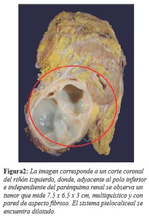 La imagen corresponde a un corte coronal del ri&ntilde;&oacute;n izquierdo, donde, adyacente al polo inferior e independiente del par&eacute;nquima renal se observa un tumor que mide 7.5 x 6.5 x 3 cm, multiqu&iacute;stico y con pared de aspecto fibroso. El sistema pielocaliceal se encuentra dilatado.