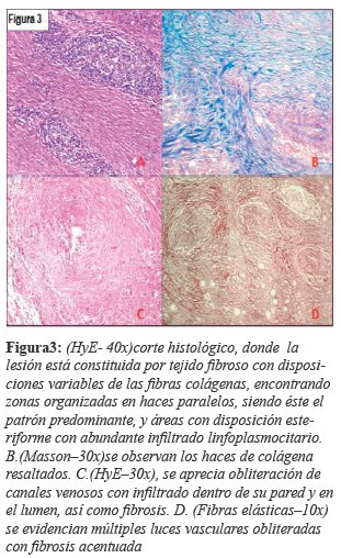 (HyE- 40x)corte histol&oacute;gico, donde la lesi&oacute;n est&aacute; constituida por tejido fibroso con disposiciones variables de las fibras col&aacute;genas, encontrando zonas organizadas en haces paralelos, siendo &eacute;ste el patr&oacute;n predominante, y &aacute;reas con disposici&oacute;n esteriforme con abundante infiltrado linfoplasmocitario. B.(Masson&ndash;30x) se observan los haces de col&aacute;genaresaltados. C.(HyE&ndash;30x), se aprecia obliteraci&oacute;n de canales venosos con infiltrado dentro de su pared y en el lumen, as&iacute; como fibrosis. D. (Fibras el&aacute;sticas&ndash;10x)se evidencian m&uacute;ltiples luces vasculares obliteradascon fibrosis acentuada
