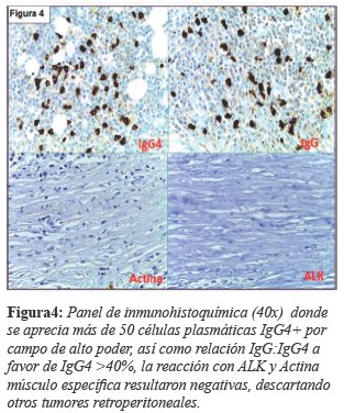 Panel de inmunohistoqu&iacute;mica (40x) donde se aprecia m&aacute;s de 50 c&eacute;lulas plasm&aacute;ticas IgG4+ por campo de alto poder, as&iacute; como relaci&oacute;n IgG:IgG4 a favor de IgG4 >40%, la reacci&oacute;n con ALK y Actina m&uacute;sculo espec&iacute;fica resultaron negativas, descartando otros tumores retroperitoneales.