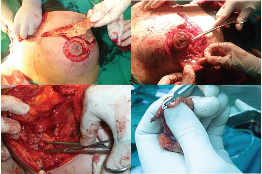 Aspecto macroscpico de la piel y el tejido profundo luego de inyeccin de sustancia algena