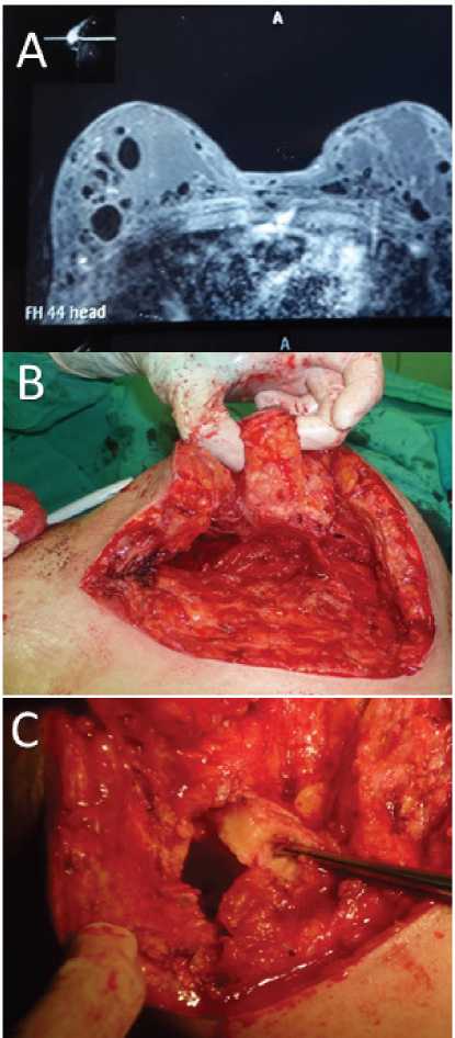 Aspecto macroscpico de tejido mamario con reaccin a cuerpo extrao que muestra cavernas visibles por resonancia magntica nuclear.
