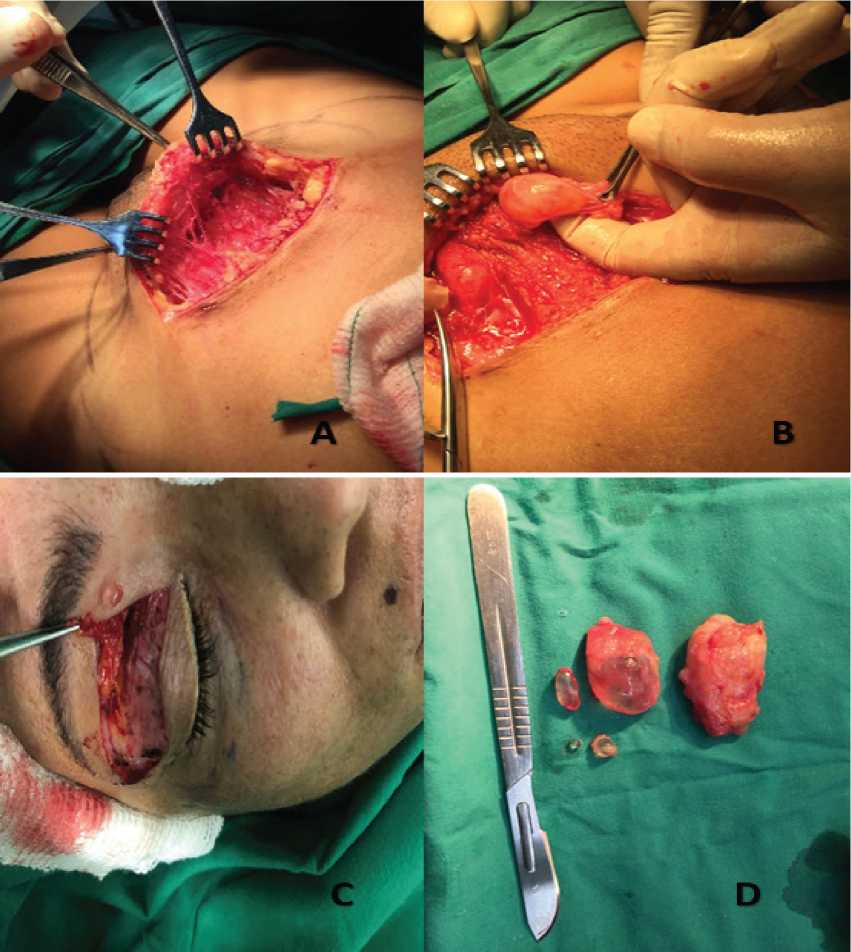 Aspecto macroscpico con formaciones nodulares con aspecto de perlas.