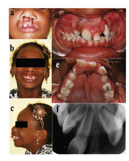 Caracter�sticas faciales, intraorales y radiogr�ficas PREVIAS a palatoplastia secundaria (paciente con 6 a�os de edad)