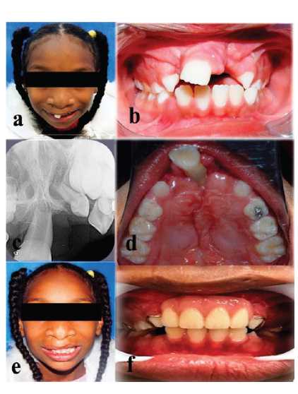 Caracter�sticas faciales, intraorales y radiogr�ficas POSTERIORES a palatoplastia secundaria (paciente con 8 a�os de edad).