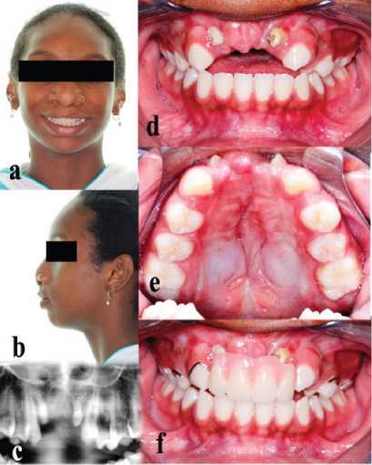Caracter�sticas faciales e intraorales despu�s de 3 a�os de seguimiento (paciente con 11 a�os de edad).