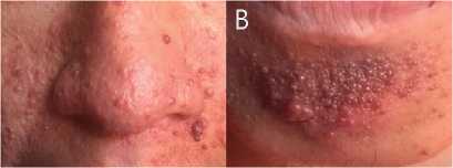Vista frontal. Angiofibromas centrofaciales