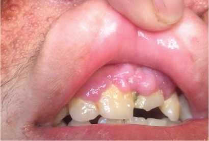 Lesiones del esmalte dental y fibroma en mucosa gingival.