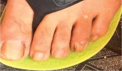 Fibroma Periungueal no Traum�tico