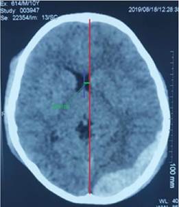 Tomograf�a Computarizada cerebral con desviaci�n de la l�nea media Nota Se aprecia una desviaci�n de la l�nea media de 6 mm