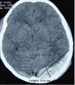 Medidas del hematoma epidural en Tomograf�a Computarizada cerebral sin contraste. Nota: En su ventana parenquimatosa podemos describir una lesi�n hiperdensa biconvexa que corresponde al hematoma epidural supra e infratentorial que abarca 20 cortes de la tomograf�a ubicado en la fosa posterior en la regi�n occipital y parietal, las medidas de este hematoma son 10 cm de alto, 8,5 cm de largo y 2,3 cm de ancho.