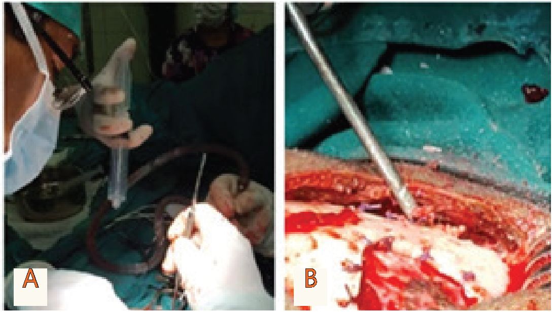 Acto quir�rgico Nota A: posici�n dec�bito ventral con la que se oper� B: craneotom�a junto con el lavado profuso y la colocaci�n de los puntos de Dandy