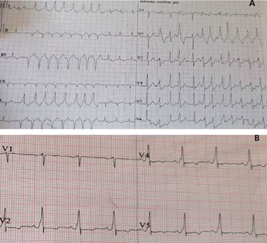 A y B. En la tomograf�a de t�rax se observa masa mediastinal que compromete principalmente el mediastino posterior, rodea la tr�quea, mide 8.7 x 6.7 x 8.4 cm de di�metro transversal, anteroposterior y cr�neocaudal, respectivamente con vascularizaci�n en su interior.