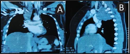 A Taquicardia supraventricular de reentrada intranodal y fibrilaci�n auricular. B. En el EKG hay presencia de la onda Delta, con preexcitaci�n ventricular tipo B t�pico de WWP, posterior al manejo con amiodarona.