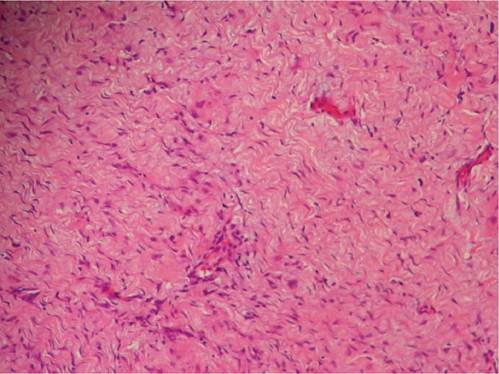Biopsia que report� neoplasia mesenquimal de abundante tejido extracelular organizada de aspecto fibrilar entremezclada con c�lulas fusiformes y estrelladas con citoplasma eosinofilico, sin atipia compatible con Neoplasia Mesenquimal Neurofibroma.
