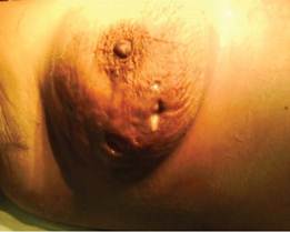 Tuberculosis de mama derecha